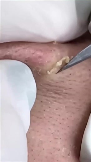 #blackheadremoval #blackhead #removal #black #head