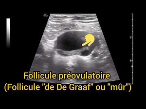Ovaire normal Follicule de De Graaf (Follicule préovulatoire ou mûr) Échographie