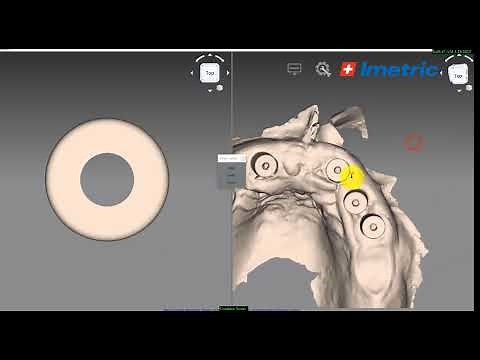 Single Arch Imetric4D scan and combine
