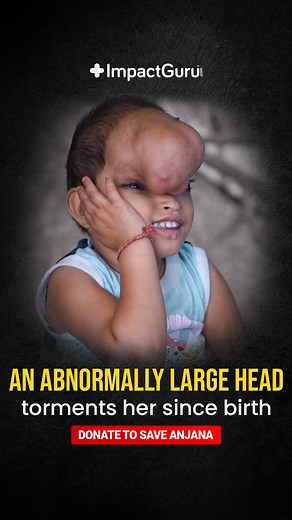 “I am just a labourer. My income isn’t enough for the multiple surgeries that my 5 y/o needs to recover from a rare facial deformity!” Please help: impactguru.com/s/zT7tnn | Impact Guru