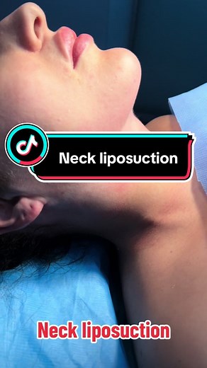 Neck liposuction #rhinoplasty #rhinoplastyturkey #rhinoplastyjourney #necklift #facelift #facelifting #neckliposuction