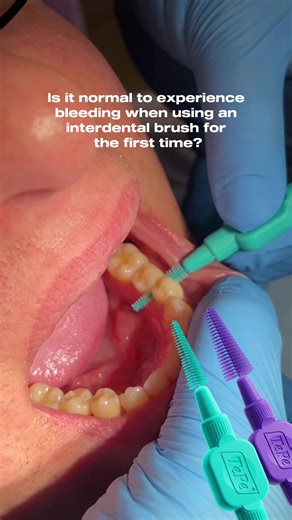 Bleeding Gums and Interdental Brushes: What to Expect