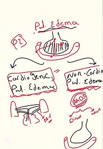 362K views · 5.6K reactions | Pulmonary Edema cardiogenic pulmonary edema Non cardiogenic pulmonary edema(ARDS) left ventricular failure (LVF) د.كمال | تعليم الأشعة المقطعية - أشرف الشاعر | Facebook