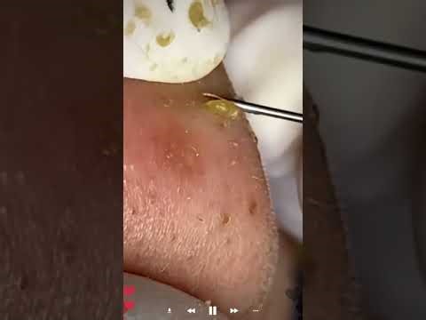 Skincare | Blackheads Removal #713 #tweezers skincare #blackheads blackheads