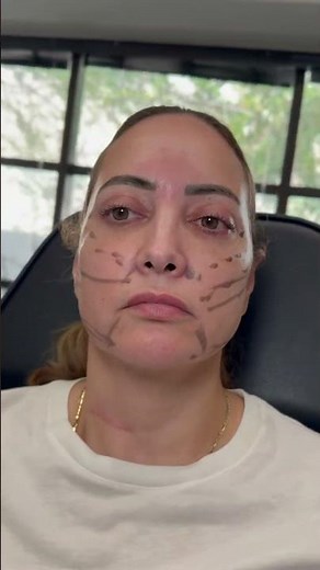 PDO Thread Lift: Your Non-Surgical Facelift Solution! 💫
