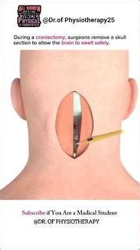 Craniectomy Surgery Explained in 60 Seconds | Medical Awareness #medicalshorts