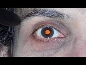 9. How to Assess the Lens and Vitreous Humour Using the Red Reflex