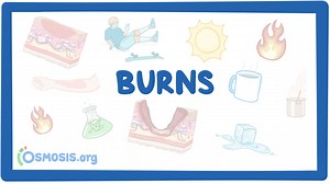 Burns: Video & Meaning | Osmosis