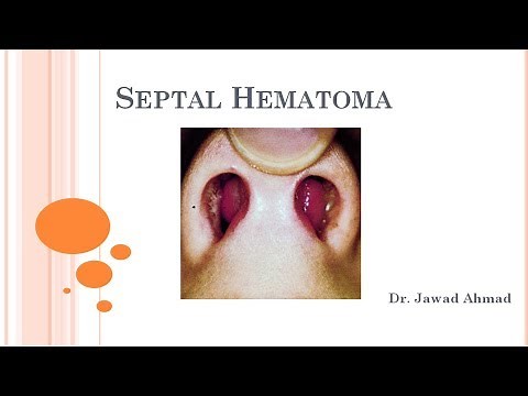Nasal Septal Hematoma - Explained for Medical Students