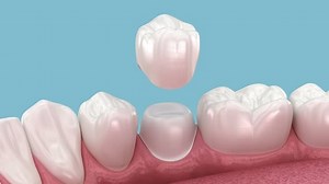 Dental ceramic crown placement. Dental 3D animation