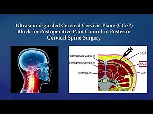 Ultrasound-guided Cervical Cervicis Plane (CCeP) Block