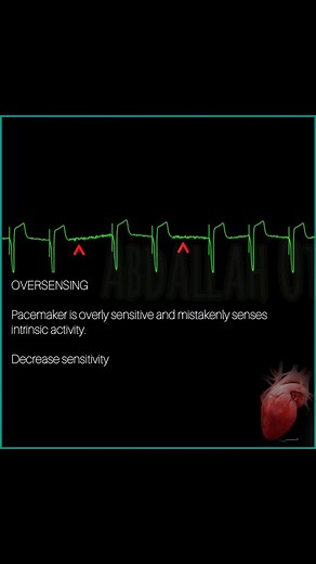 Advanced Pacemaker Troubleshooting: ECG Patterns & EP Solutions⚡💡 1. Failure to Capture 2. Failure to Pace 3. Undersensing 4. Oversensing #Electrophysiology #Pacemaker #ECG #Arrhythmia | Abdallah Othman
