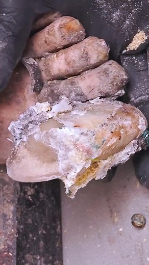 Smooth Ingrown Toenail Extraction Technique Part 7 | Ashik 0.2