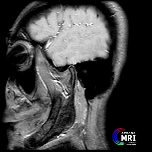 Dynamic MRI of temporomandibular( TMJ )ening movement of jaw @dvanced_mri #radiology #mandible