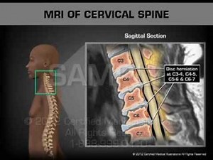 MRI of Cervical Spine