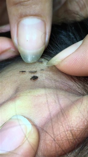 Remove lice #lice😰😰😰 #liceremoval #😱😱😱 #😭😭😭 | lice removals