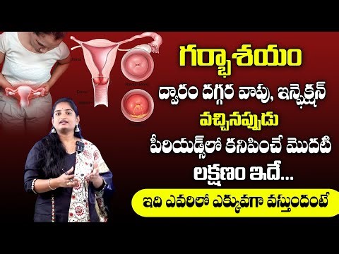 Cervicitis – Symptoms, Causes, Diagnosis, Treatment, Complications | Tejaswai #magnatvdoctors