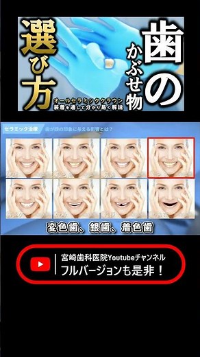 【 かぶせ物の選び方 】オールセラミッククラウン装着の様子を通して分かり易く解説します