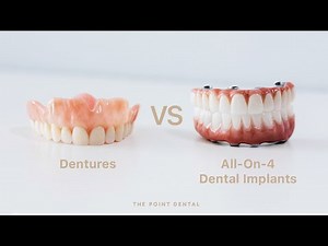 Dentures vs All-On-4 Dental Implants – Which Is Best? Pros, Cons & Cost Explained | The Point Dental