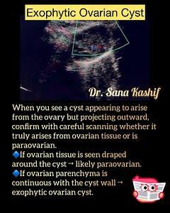 21K views · 275 reactions | When you see a cyst appearing to arise from the ovary but projecting outward, confirm with careful scanning whether it truly arises from ovarian tissue or is paraovarian. • If ovarian tissue is seen draped around the cyst → likely paraovarian. • If ovarian parenchyma is continuous with the cyst wall → exophytic ovarian cyst. | Sana Kashif | Facebook