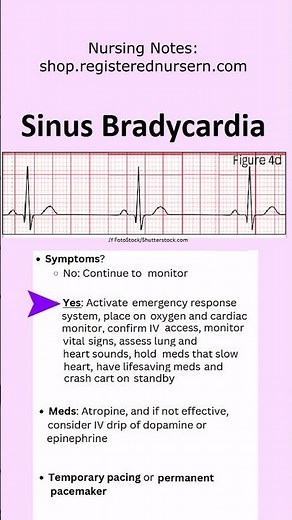 Sinus Bradycardia ECG EKG Nursing: Treatment, Rhythm Made Easy in Less Than 1 Minutes #nursing #ecg