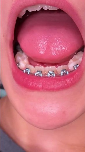 What is Phase One orthodontic treatment - Tooth Time Family Dentistry New Braunfels