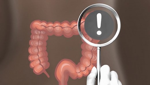 Don't skip colonoscopy for new blood-based colon cancer screening, study concludes