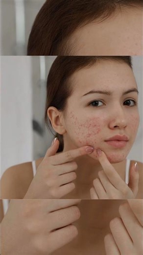 “How to Remove Pimples Fast at Home | Best DIY Remedy”✨💞#shorts#viral#trending#skincare#shortsfeed