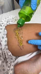 Tattoo Removed with a Groundbreaking Method