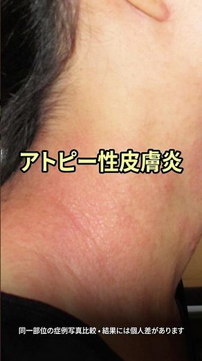 アトピー性皮膚炎 治療前後（同一部位）｜症例写真｜ソウル