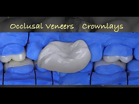Table Top Prostheses for the Posterior Dentition with Video Demonstration
