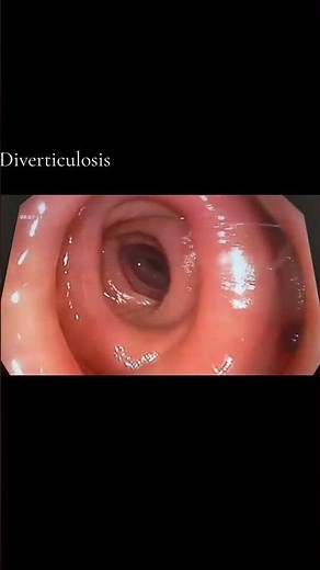 Colonoscopy Footage: Extensive Diverticulosis#Endoscopy #GutHealth