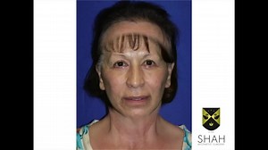 Facelift Before and After video