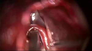 File:Endoscope-assisted microvascular decompression in hemifacial spasm with a teflon bridge.webm - Wikimedia Commons