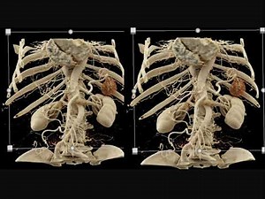 MDCT Evaluation of the Spleen: Challenges in Diagnosis Part 2