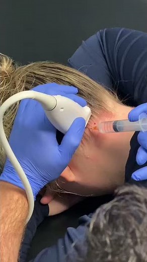 Suboccipital Nerve Block with Dr. Verde