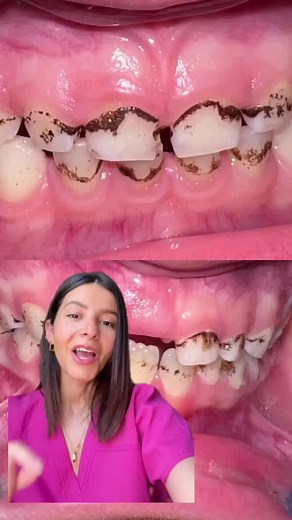 Black Stains on Teeth: Causes, Solutions & Dental Care Tips