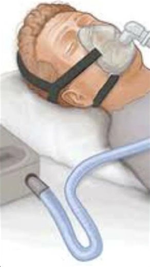 openforum PSA for sleep apnea snoring