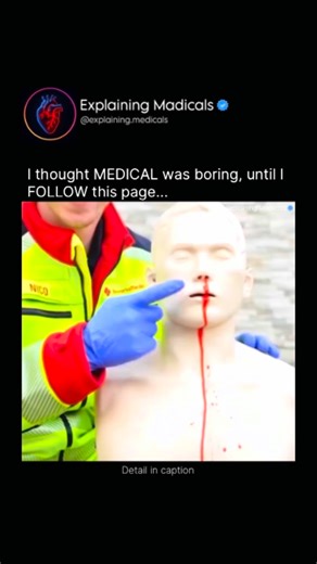 Medical | Health | Anatomy | If a nosebleed happens, staying calm and acting correctly can stop it quickly and safely. First, sit upright and lean slightly forward.... | Instagram