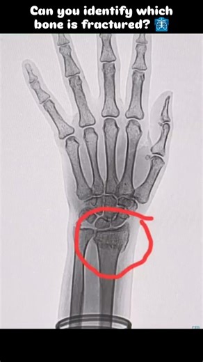 Ultra Scan Imaging Center on Instagram: "Can you identify which bone is fractured? 🩻 This hand X-ray (wrist X-ray AP view) clearly shows a distal radius fracture, which is a very common wrist fracture seen after trauma, fall on outstretched hand (FOOSH injury) or accident. In this X-ray image of hand and wrist, the radius bone near the wrist joint shows a visible fracture line, making digital X-ray imaging essential for accurate fracture detection and radiology diagnosis. Such orthopedic X-ray 