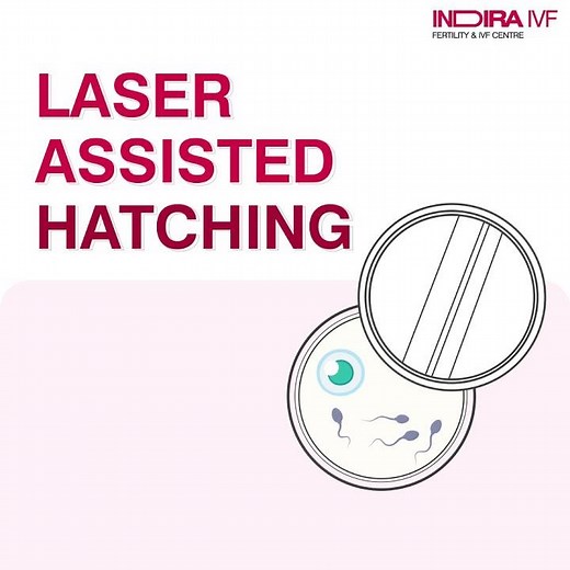 Laser Assisted Hatching | Advance Infertility Technology | 100+ Centers