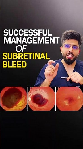Successful Management of Sub-retinal Bleed