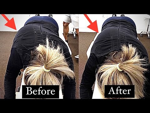 Straightening *SEVERE SCOLIOSIS* with Chiropractic Adjustments!