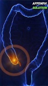 Appendix Treatment #appendix #appendixsurgery #appendixpain #appendixtreatment #drakhtar | Akhtar Homeo Clinic-Multan