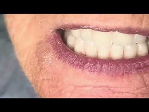 Magnetic dentures, an attractive solution