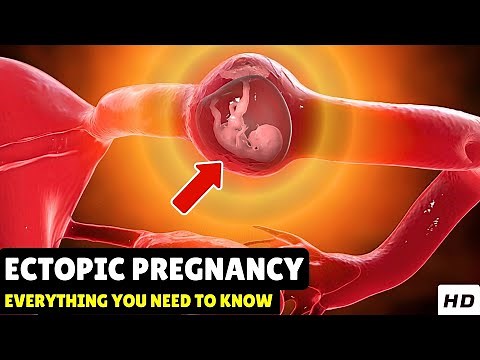 Ectopic Pregnancy – Causes, Signs and Symptoms, Diagnosis & Treatment