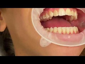 Invisalign Attachments On