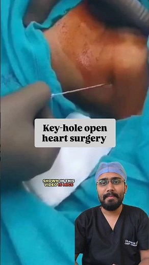 Ever wondered how Key hole open heart surgery is done?