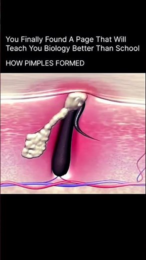 how pimple formed
