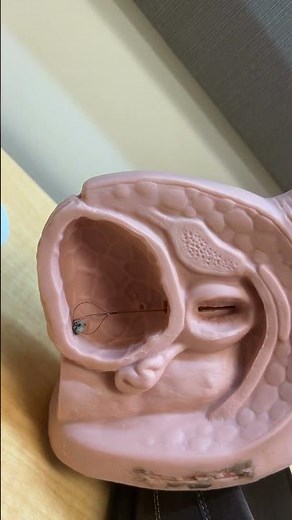 Removing bladder stones